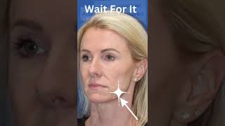 The Facelift That Makes Women LOOK 10 YEARS YOUNGER [upl. by Franky457]