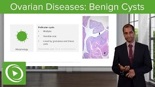 Ovarian Diseases Benign Cysts – Pathology  Lecturio [upl. by Anitselec]