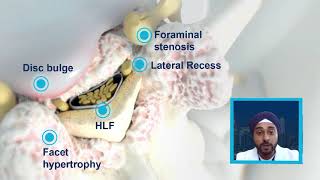 NYNJ Abstract  Mild Treatment Outcomes in the Presence of Foraminal Narrowing [upl. by Ailemrac158]