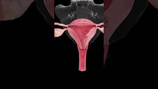 🎗️ Understanding Endometrial Cancer A Growing Concern for Women’s Health 🎗️ [upl. by Pierpont]