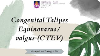 LESSON 8 CONGENITAL TALIPES EQUINOVARUSVALGUS CTEV [upl. by Kevan]