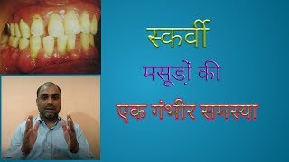 What is scurvyScurvy and Vitamin C  ScurvyTreatment of Scurvy  Symptoms of Scurvy Bleeding Gums [upl. by Sansbury]