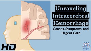 Intracerebral Hemorrhage Unveiled Understanding the Whys Whats and Hows [upl. by Binnings]