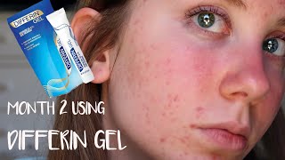 MONTH 2 USING DIFFERIN GEL  Skin Update [upl. by Ynneb997]