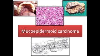 Mucoepidermoid carcinoma [upl. by Aneehsak]