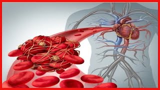 Embolie pulmonaire  symptômes et traitement [upl. by Asabi]