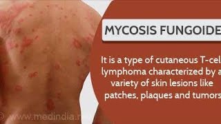 Mycosis Fungoides  Cutaneous T cell Lymphoma  Causes Diagnosis and Treatment [upl. by Rimahs]