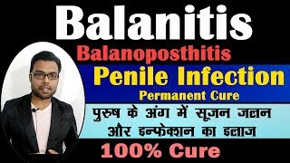 Treatment Of Balanitis  पुरुष के अंग में सूजन जलन और इन्फेक्शन का इलाज  Balanitis  Balantis [upl. by Enyar673]