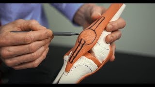 How do I choose a graft for ACL reconstruction  Stanford Childrens Health [upl. by Cronin]