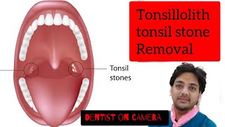 Tonsil stone  Tonsillolith  Live Removal of Tonsil stones  symptoms amp treatment dentistoncamera [upl. by Ledba]