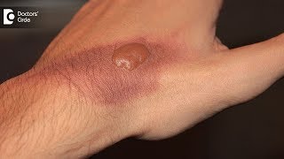 How to treat a burn blister at home Tips to avoid burn scar  Dr Pavan Murdeshwar [upl. by Julie]