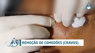 Comedão Comedone  Ep 03 vídeo rápido  extração de cravos [upl. by Lampert]