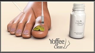 YOFEE CLEAR Purity Nail  Natural Nail Fungus Treatment  Natürliche Nagelpilz Behandlung [upl. by Mcnully722]