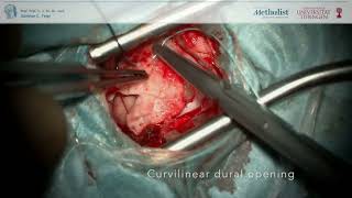 Microvascular Decompression for Hemifacial Spasm Minimally Invasive Surgery [upl. by Avan]