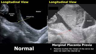 Obstetric Ultrasound Normal Pregnancy Vs Placenta Previa  LowLying Marginal Partial Complete [upl. by Cammy426]