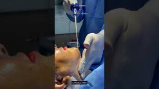 Double Chin Liposuction  Redefining Beauty  Cosmetico by Dr Kamal [upl. by Broddie]