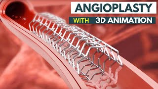 Angioplasty Procedure Explained How It Saves Lives  What Is Angioplasty StepbyStep Explanation [upl. by Khan109]