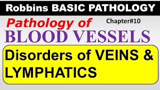 Ch10  Disorders of Veins amp Lymphatics  Blood Vessel Pathology  Robbins Lectures [upl. by Randy857]