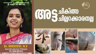 അട്ട ചികിത്സ  Leech Therapy Malayalam  Leech Therapy Benefits  Dr Sreedevi [upl. by Vick386]