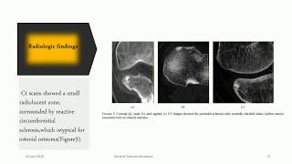 Osteoid Osteoma [upl. by Carma]