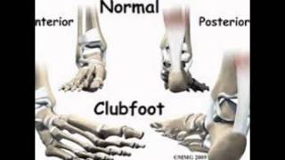 positional talipes treatmenttalipes equinovalgus treatmenttalipes calcaneus treatment for clubfoot [upl. by Stephi]