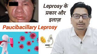 Paucibacillary Leprosy  Leprosy के प्रकार और इलाज़  नसों को नुकसान पहुंचाने वाली कुष्ट रोग leprosy [upl. by Ahern]