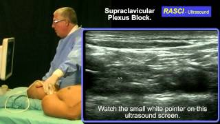 Ultrasound guided Supraclavicular plexus block [upl. by Yerrot]