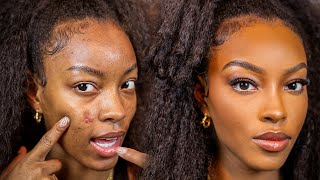 How to Cover Up Acne Blemishes and Active Acne [upl. by Anomer]