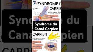 Syndrome du Canal Carpien canalcarpien paresthesie nerf Median medianetchannel neurologie comp [upl. by Madson]