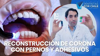 Elección de Pernos y Adhesivos  Clínica Dentistas por Chile [upl. by Natan]