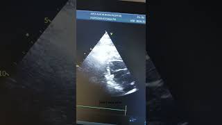 2D Echo Cardiography parasternal short axis view [upl. by Almita]