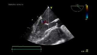 CARDIAC ARREST CARDIOPULMONARY RESUSCITATION [upl. by Carleen]