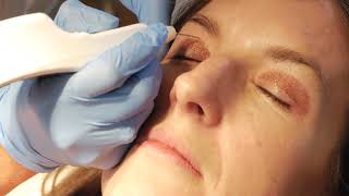 Non surgical blepharoplasty with PLEXR [upl. by Martijn]