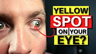 Yellow SPOT On Your Eye  Pinguecula Explained [upl. by Alyda607]