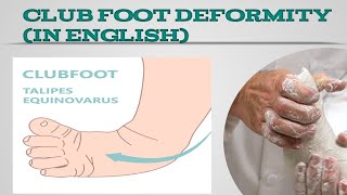 Club Foot DeformityTalipes equinovarusEasy Lecture In English [upl. by Earezed]