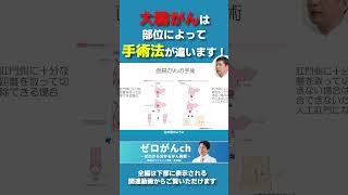 大腸がんは部位によって手術法が違います！ 大腸がん 大腸癌 がん治療 [upl. by Nadab]