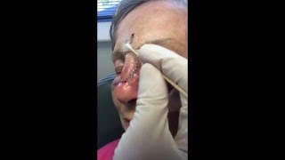 Cleaning Facial Stiches [upl. by Yelekreb]