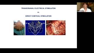 EANS Webinar Neuromonitoring in Vascular Neurosurgery [upl. by Noloc]