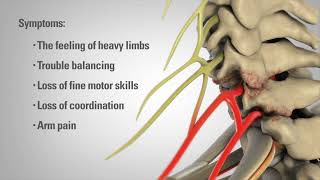 Cervical Laminectomy  Patient Animation [upl. by Monaco]