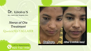 Nevus of Ota Treatment I Qswitch Ndyag laser I Dr Walias Skin and Hair Transplant Clinic [upl. by Hamel456]