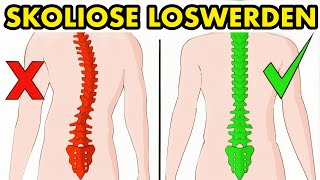 Wie man Skoliose auf natürliche Weise in 5 Minuten am Tag beheben kann [upl. by Tabber]