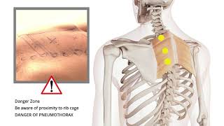 Trigger Point Release  Shoulder Pain  Rhomboids [upl. by Renat]