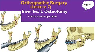 Inverted L osteotomy  Orthognathic Surgery  Oral amp Maxillofacial Surgery  Syed Amjad Shah [upl. by Nuris]