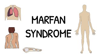 Marfan Syndrome  Simple and easy to understand [upl. by Dlopoel26]