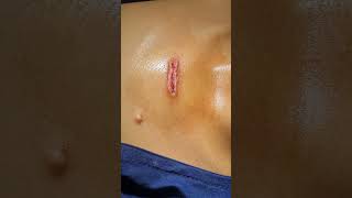 Keloid removal in 30 minutesFive monthly chemotherapy given to control recurrenceCall9700020802 [upl. by Kilar6]