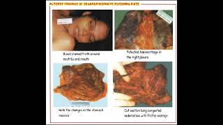 Autopsy In Case OP Poisoning Forensic Medicine amp Toxicology [upl. by Aliak678]