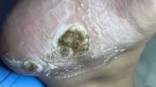 Removing dead Skin of large size Warts  Removing dead skin affected by Fungus on heel  pedicure [upl. by Vipul]