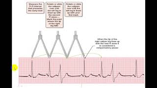 EKG EXTRASYSTOLES [upl. by Humble]