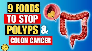 Colon Polyps and Stop Bowel 9 Foods to Fight Cancer Naturally Vitalhealth6 [upl. by Silbahc458]