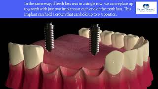 How many teeth can be replaced with dental implants Prabu Dental Karaikudi [upl. by Viehmann]